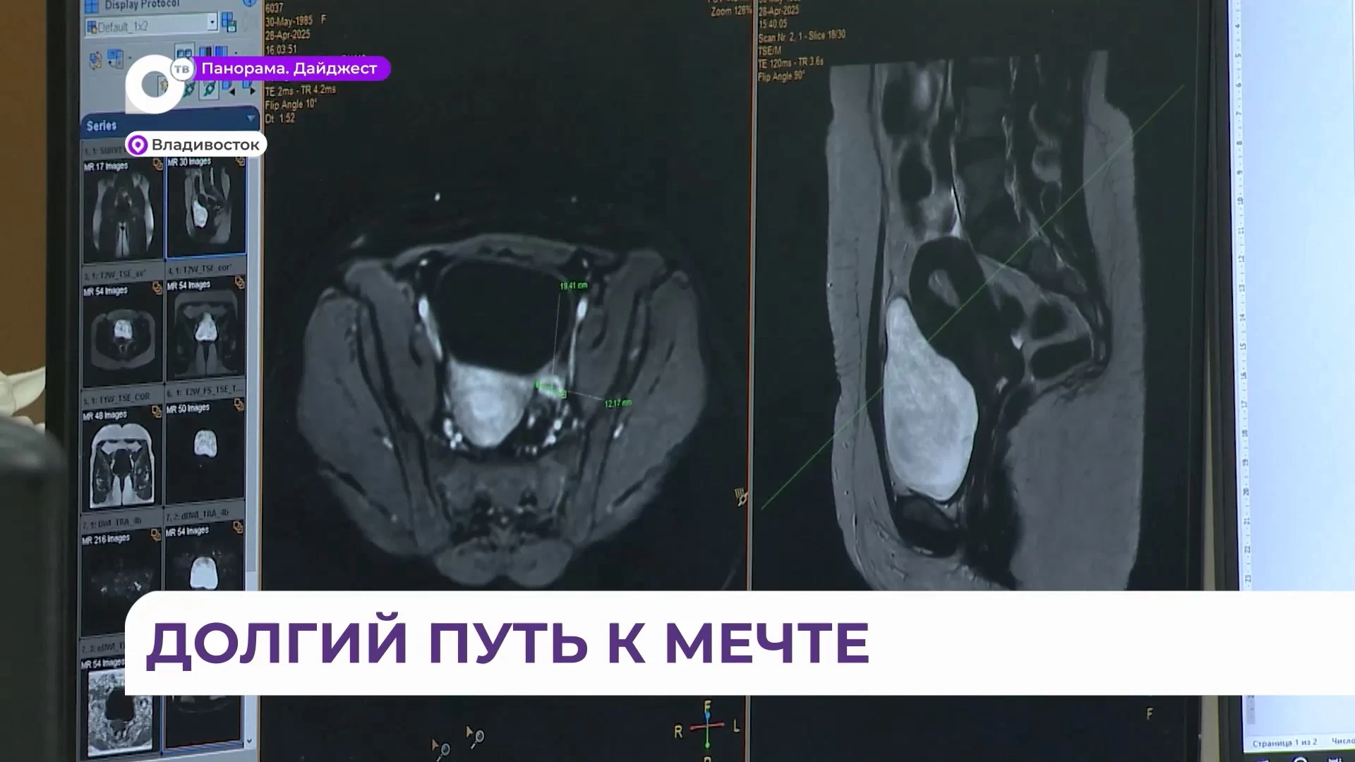 В Приморском онкодиспансере выздоравливают пациенты даже с метастазами